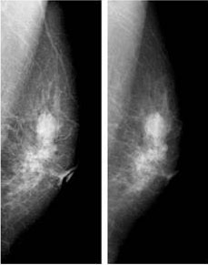 Fig. 7 Difference of Mammography