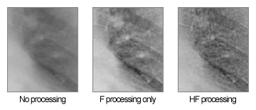 Fig. 1 Example of HF Processing (Chest)