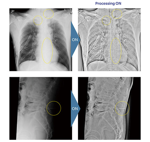 Tube and Gauze Image Enhancement