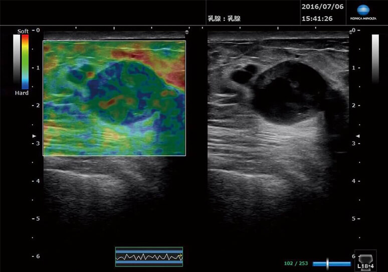 Strain Elastography