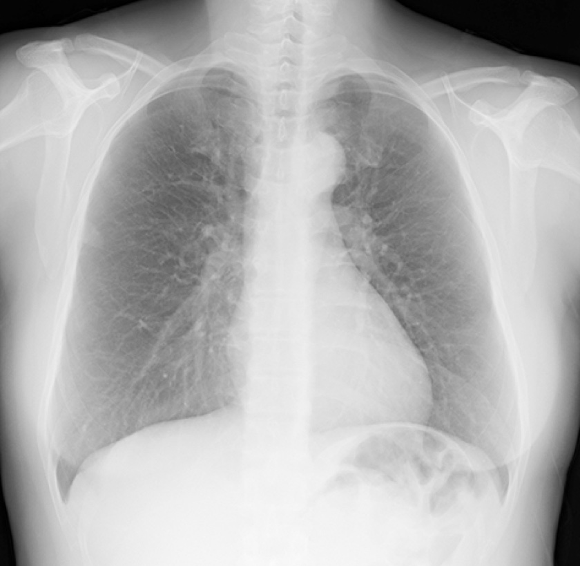 Suppression of bone signals