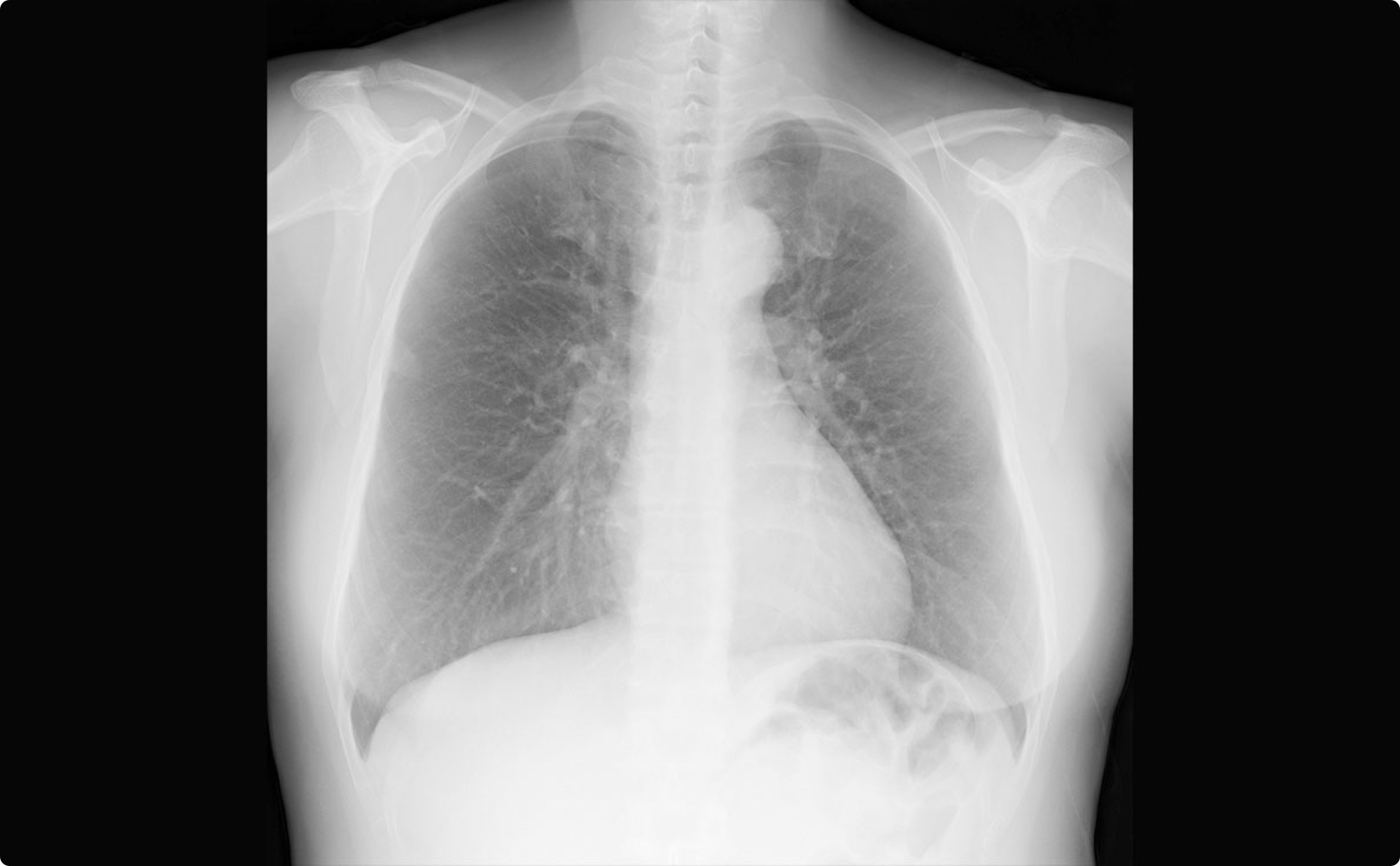 Bone Suppression Imaging