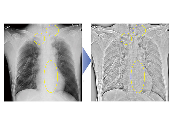 Tube and gauze image enhancement