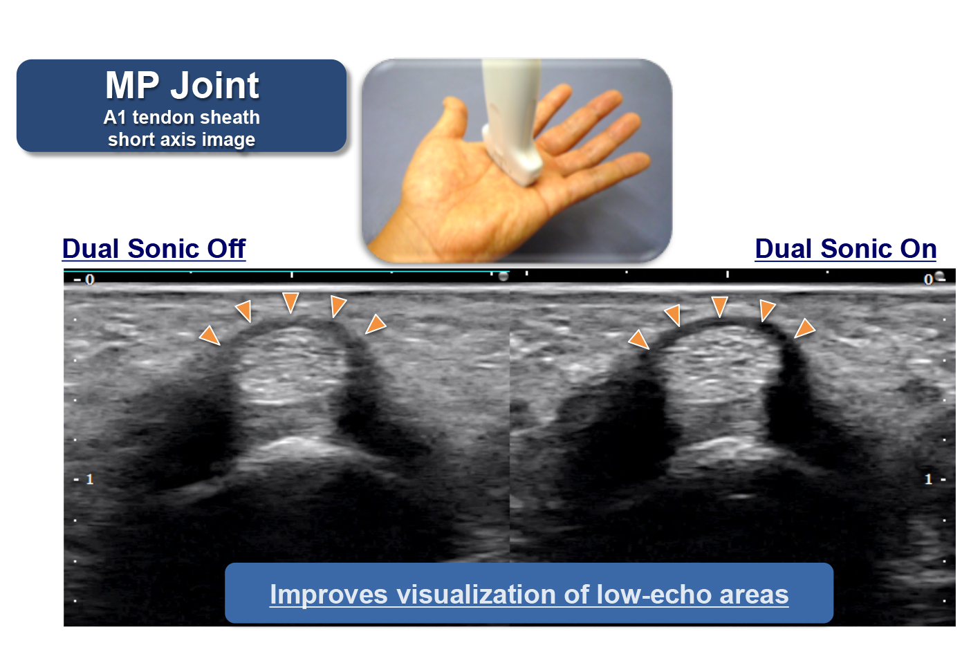 High contrast resolution is achieved by suppressing contamination of acoustic noise