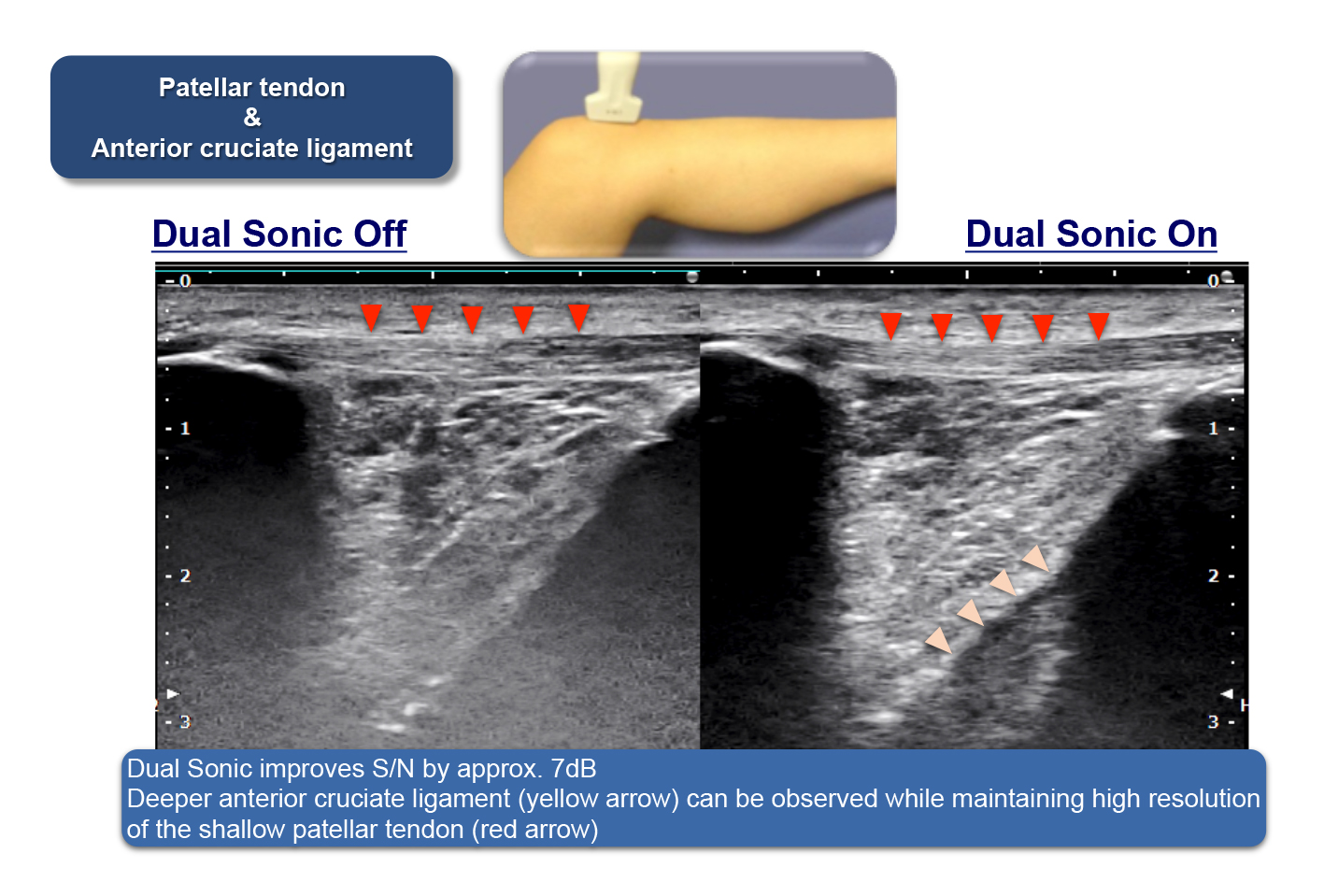 Improves S/N ratio and penetration through efficient harmonic generation