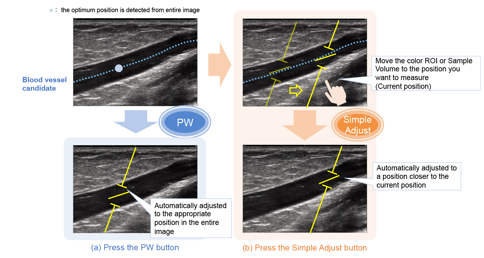 Vascular NAVI achieves Easy to use vascular ultrasound