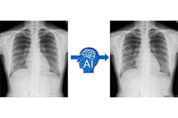 胸部X線画像診断支援AI「CXR Finding-i」の検出精度改良を達成