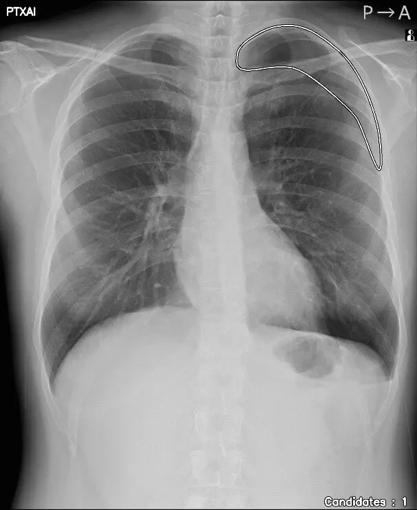 人のレントゲン写真 気胸の検出領域を表示