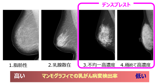 一人ひとりにとって乳がん検診をよりよいものに超音波併用検査の促進に